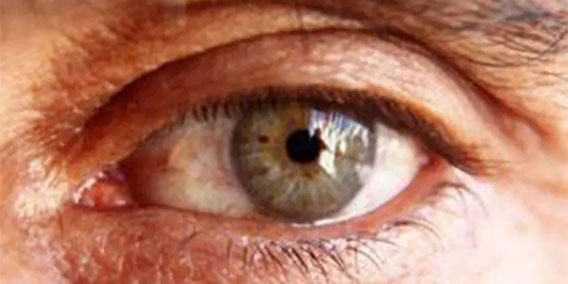 What is macular degeneration?